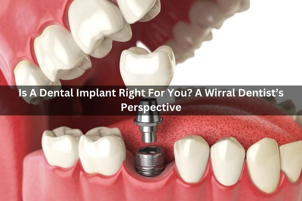 Is A Dental Implant Right For You? A Wirral Dentist’s Perspective