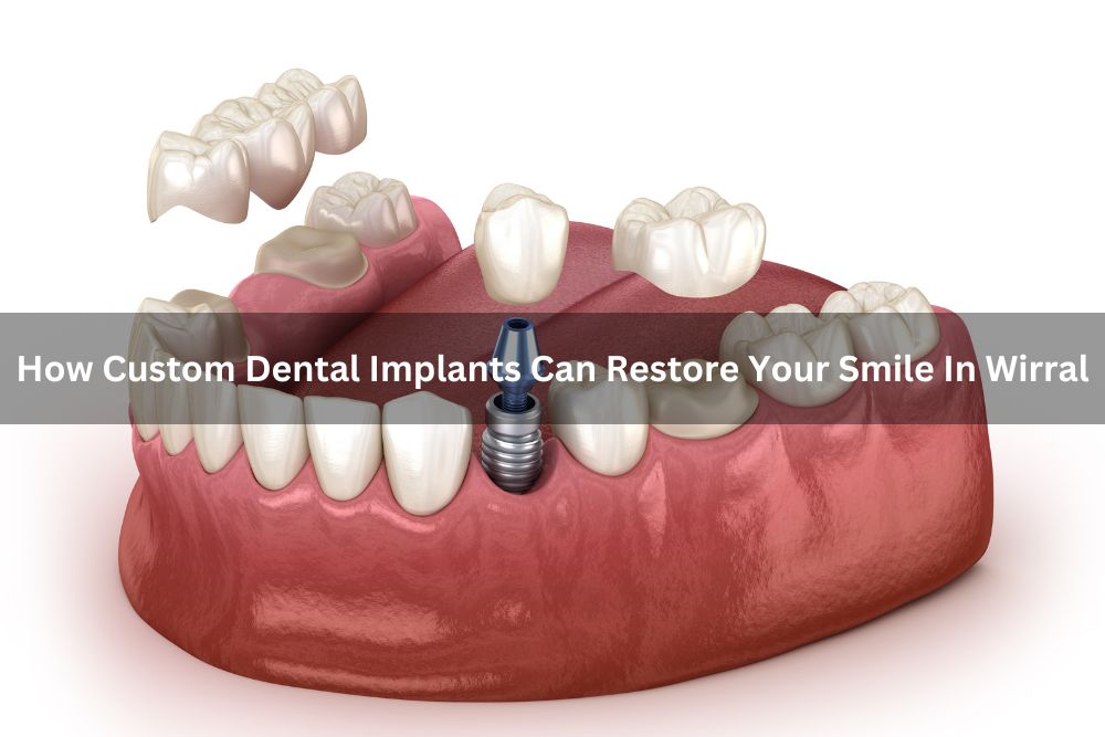 How Custom Dental Implants Can Restore Your Smile In Wirral