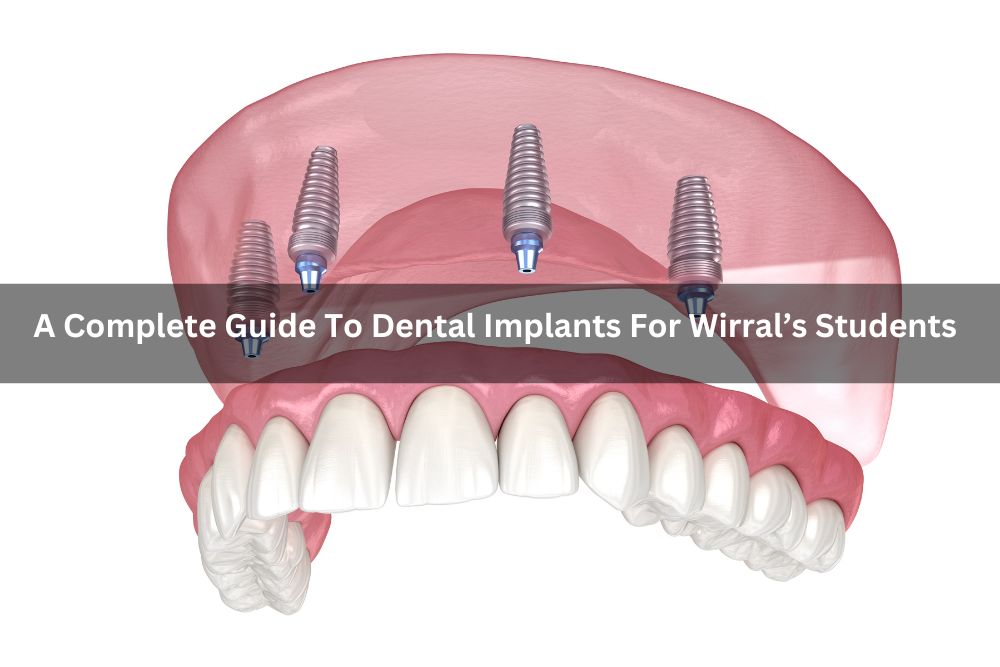 A Complete Guide To Dental Implants For Wirral’s Students